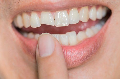 chipped tooth