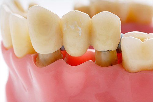 Dental Bridges Dental Bridge