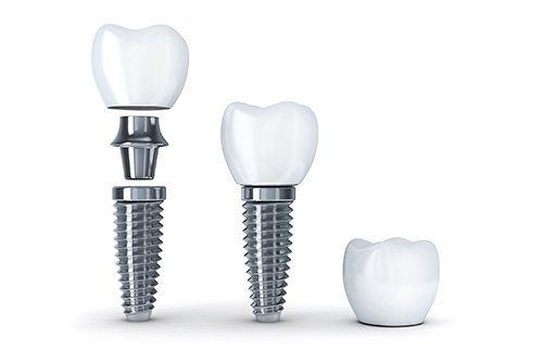 How Implants Work Showing the process of how implants work