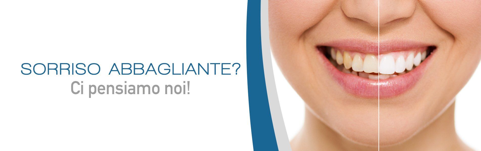 Sbiancamento Dentale