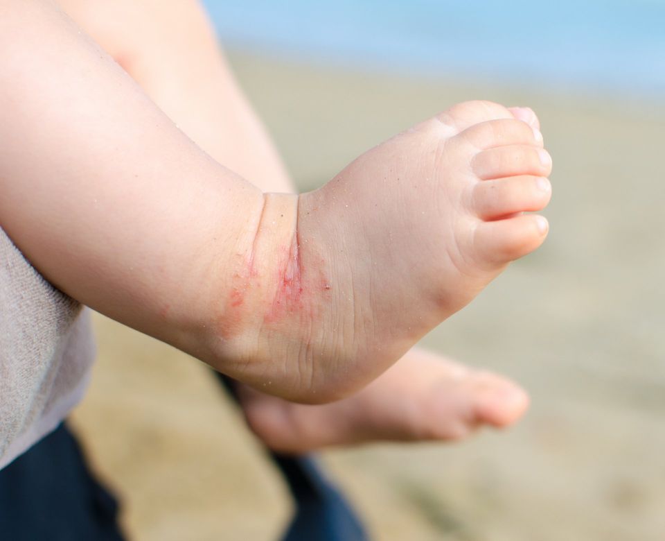 Child with Eczema