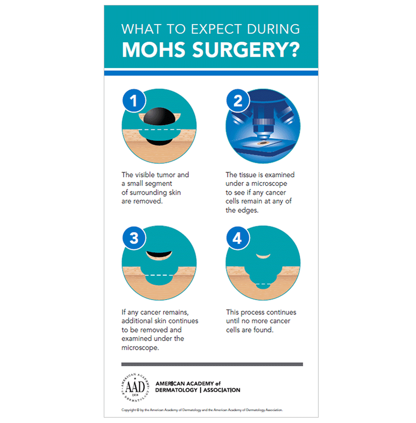 Mohs surgery diagram Skin Cancer Center of Central Florida