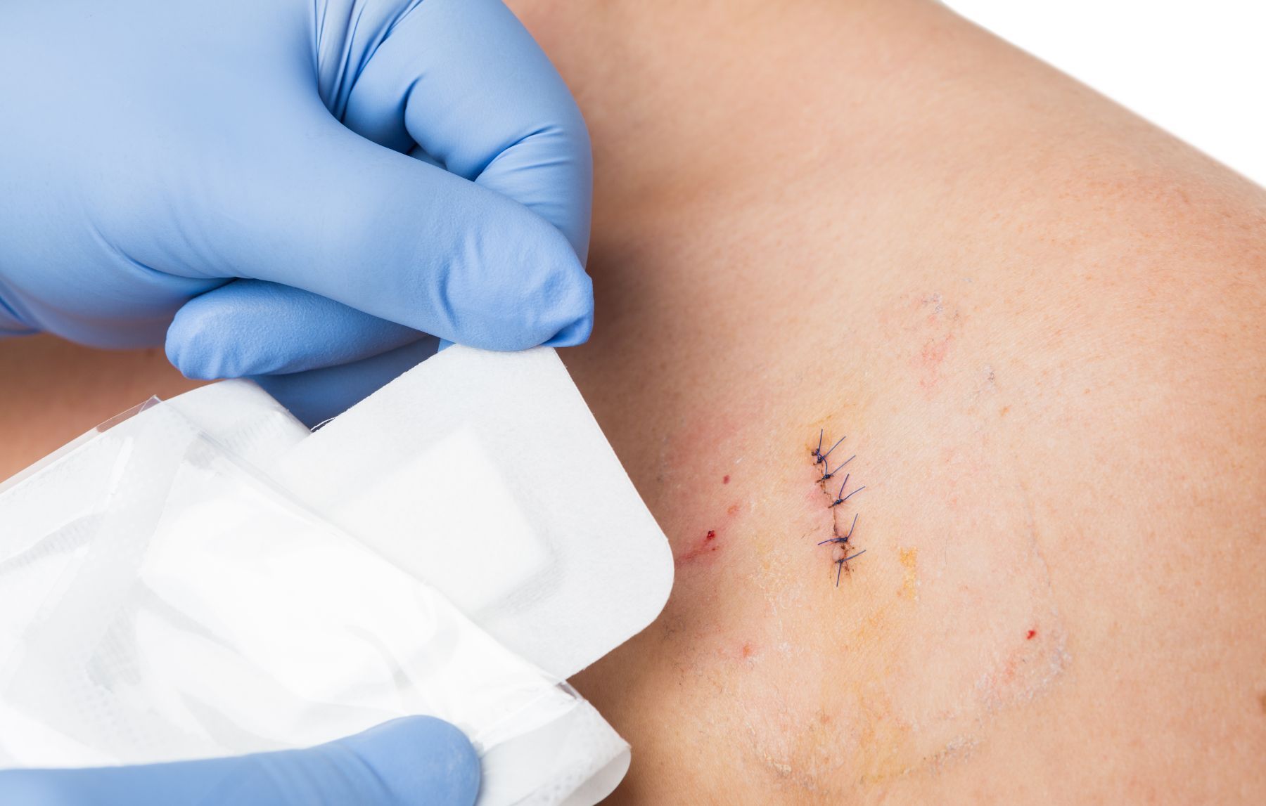 doctor applying bandage to stitched wound at Skin Cancer Center of Central Florida