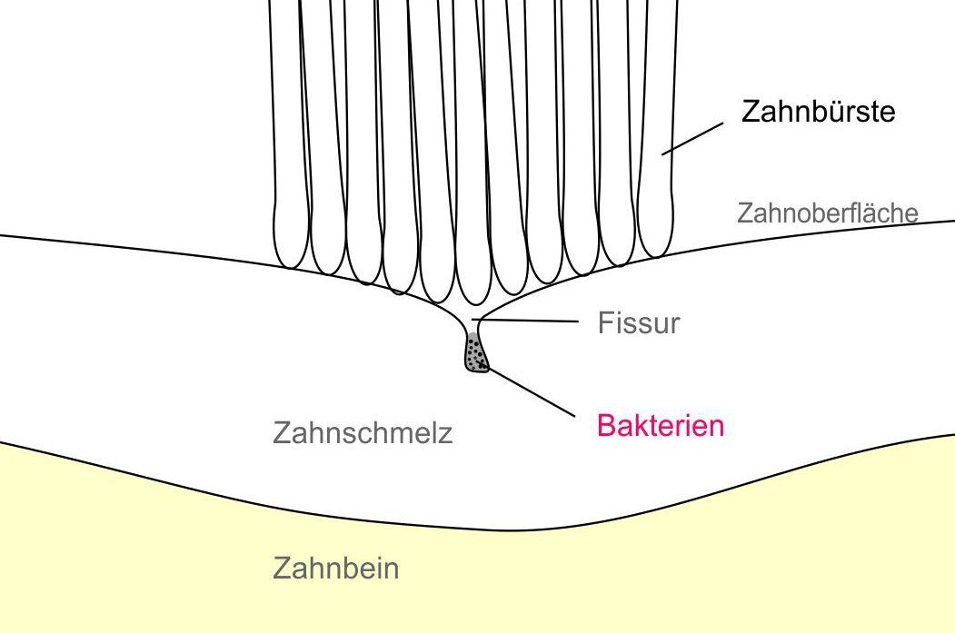 Fissurenversiegelung der Backenzähne