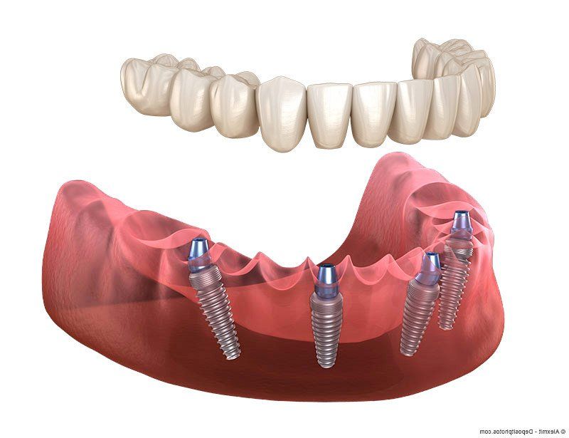 Implantatgetragene Totalprothese