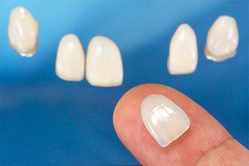 Dental Veneers