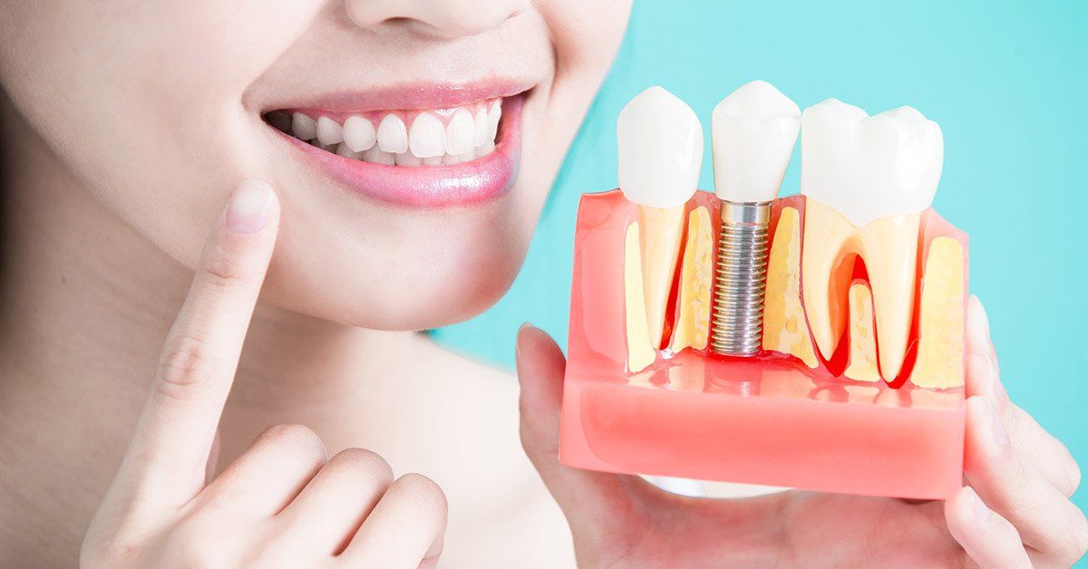 dental implants