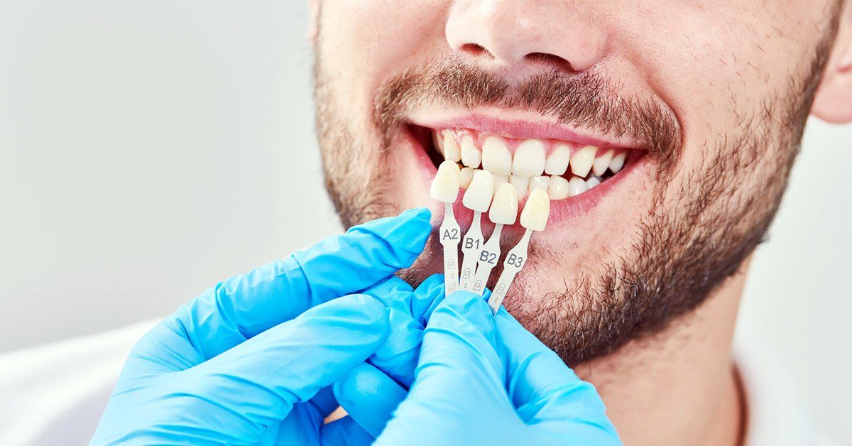 veneers process