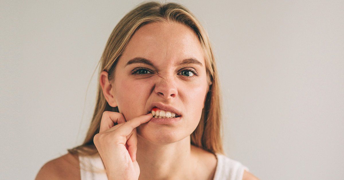 Gingivitis, Gingivitis Treatment, Gingivitis Symptoms