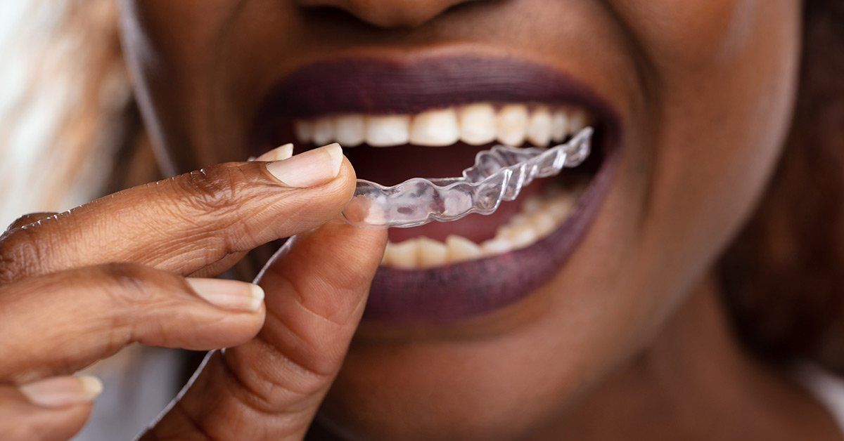 Invisalign process