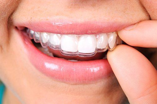 Invisalign - Invisible braces