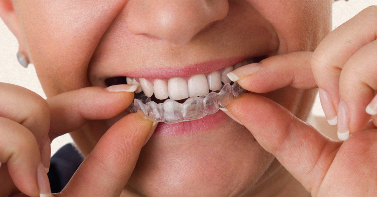 Invisalign Provider Laurel MD