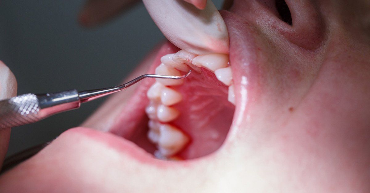 periodontitis
