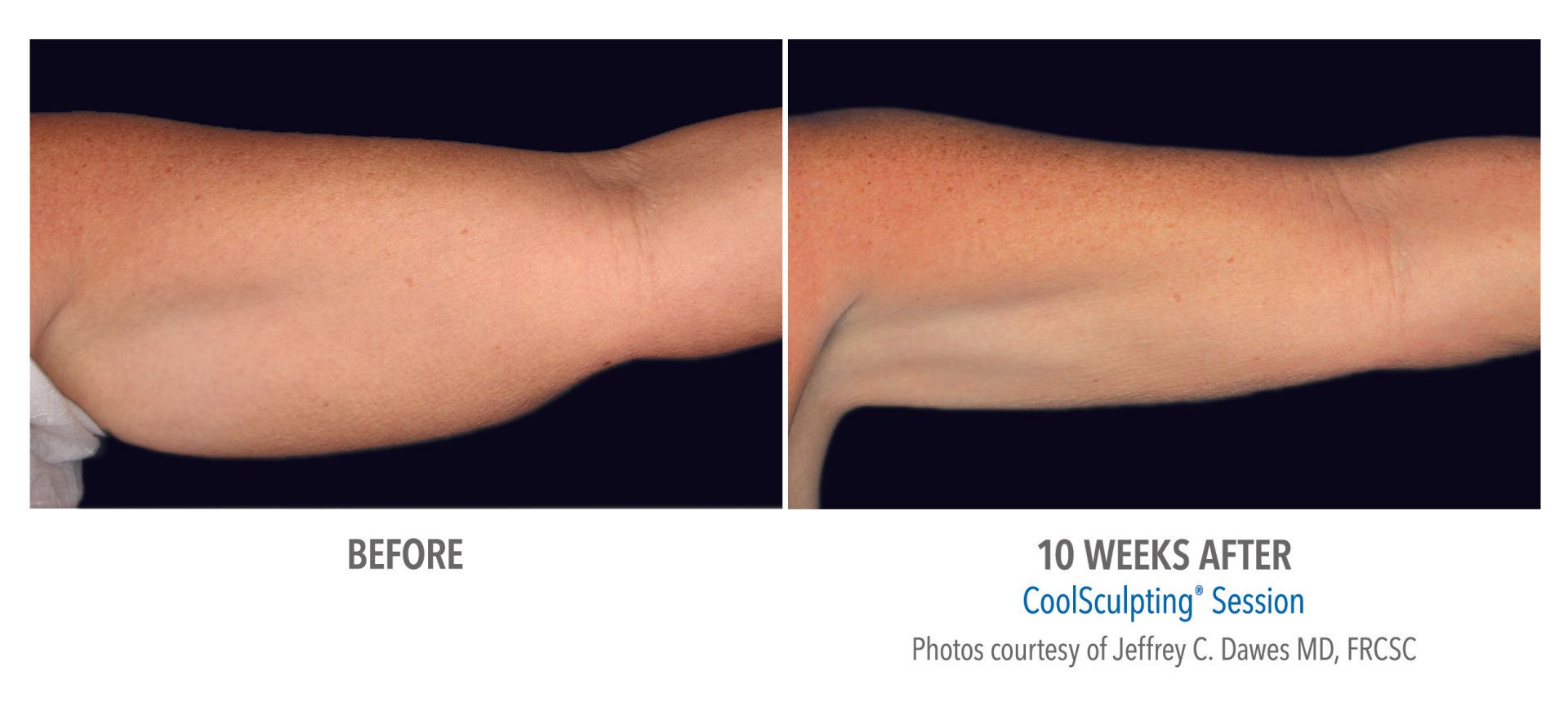 coolsculpting before after