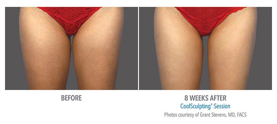coolsculpting before after