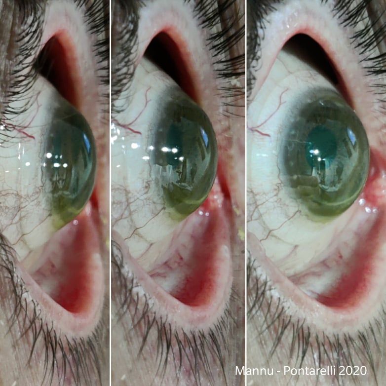 Lente Sclerale per trapianto di cornea.