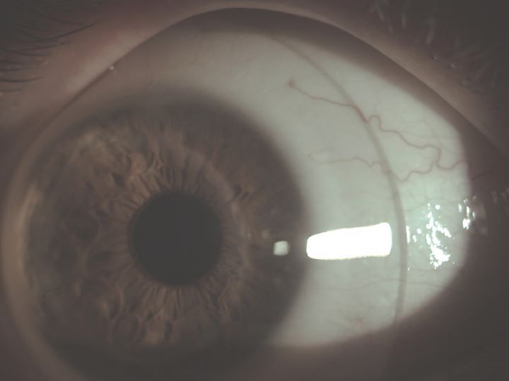 Lente Sclerale 18 mm diametro. Lente Sclerale per cheratocono. Lente Sclerale di grande diametro post trapianto di cornea. Contattologia personalizzata.
