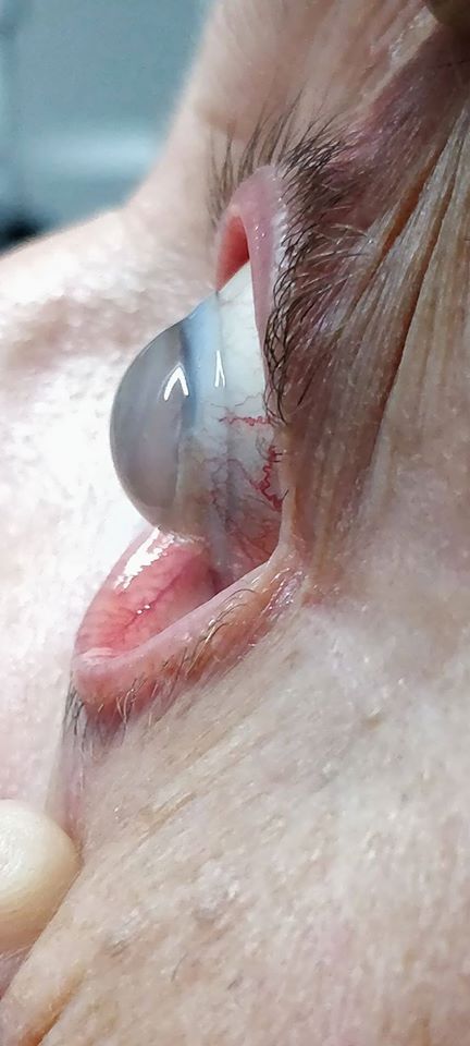Lente a contatto sclerale su cheratoplastica perforante. Mannu Claudio. Lente a contatto sclerale su cheratoplastica perforante.