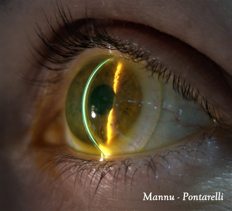 Lente sclerale su cheratoplastica. In sezione, da sinistra verso destra, si osserva la lente, il serbatoio lacrimale e la cornea sottostante. Ripresa a 10x al biomicrosopio post trapianto, post cheratoplastica, Lente Sclerale post trapianto di cornea, sclerali per chirurgia, lente sclerale per cheratocono, trapianto di cornea, lente sclerale cassino, lente sclerale ceprano