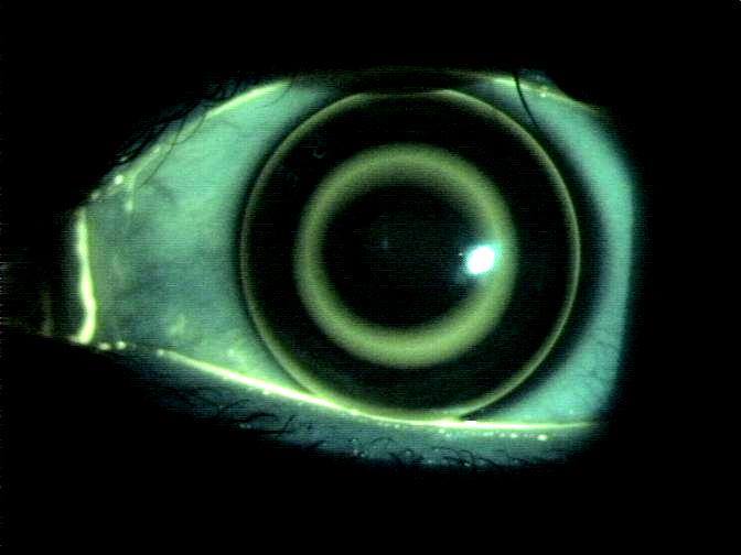 Lente a contatto per trattamento ortocheratologico. Immagine in fluorescina. ortocheratologia, ortocheratologia ceprano, ortocheratologia cassino. lenti a contatto notturne