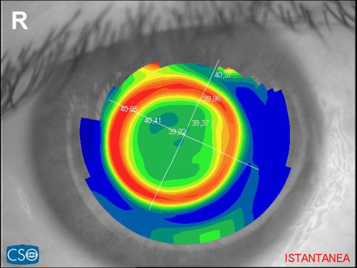 Quadro topografico di una cornea sottoposta a modellamento preciso. Ortocheratologia notturna. ortocheratologia, ortocheratologia cassino, ortocheratologia ceprano, lente a contatto ortocheratologiche, ridurre la miopia con le lenti a contatto, ridurre ipermetroipia, ortho k, ortok