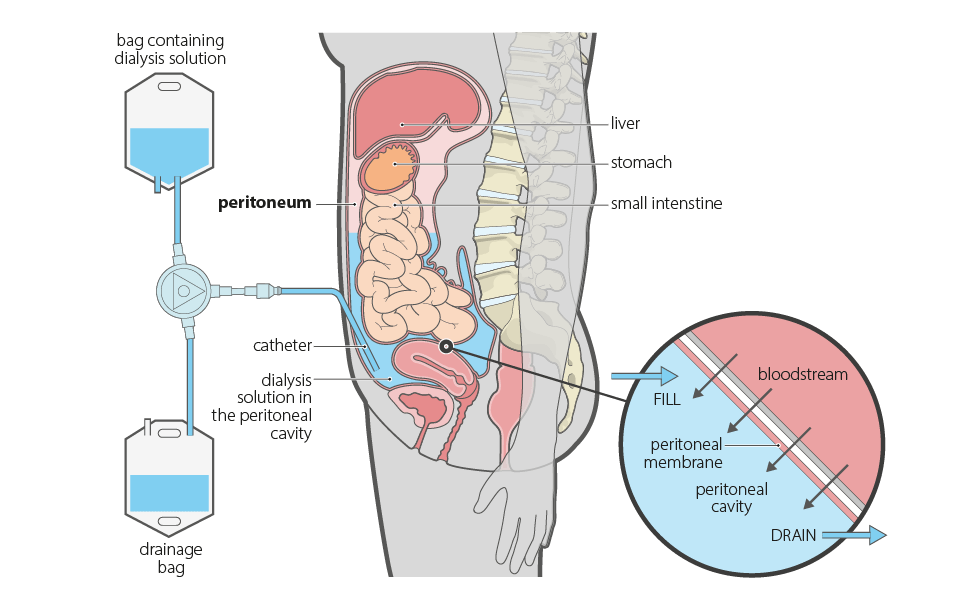 peritoneal dialysis illustration
