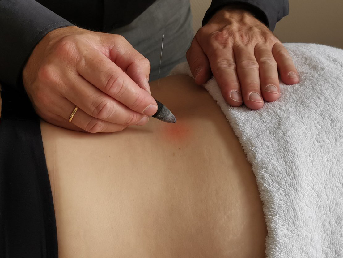 Tijdens een therapiesessie richt de therapeut een klein instrument op een rode, cirkelvormige stip op de onderrug van de patiënt.