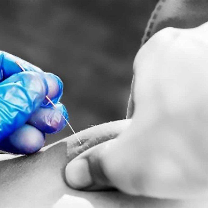 dry needling