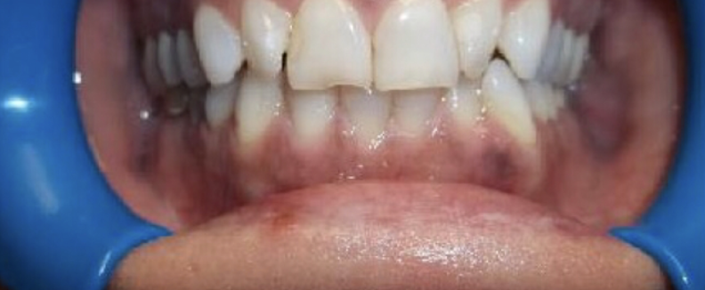 Before teeth straightening
