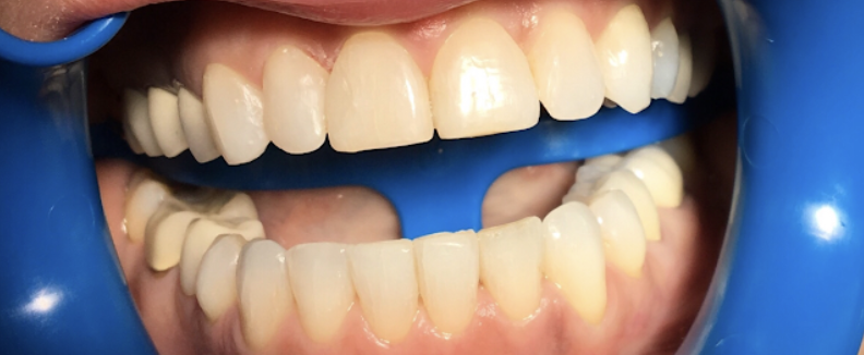 After teeth straightening