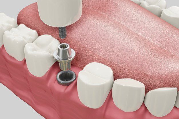 Parafuso de implante dentário sendo inserido na gengiva, cercado por dentes brancos.