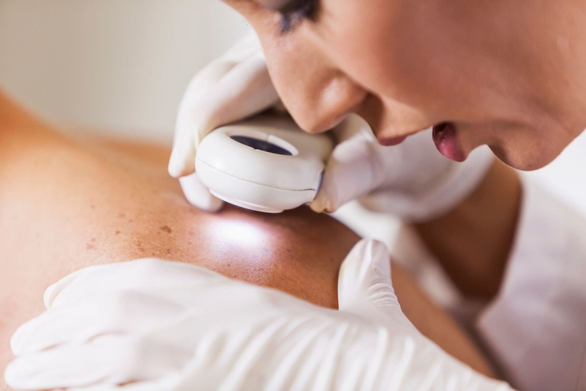 diagnosi per melanoma cutaneo