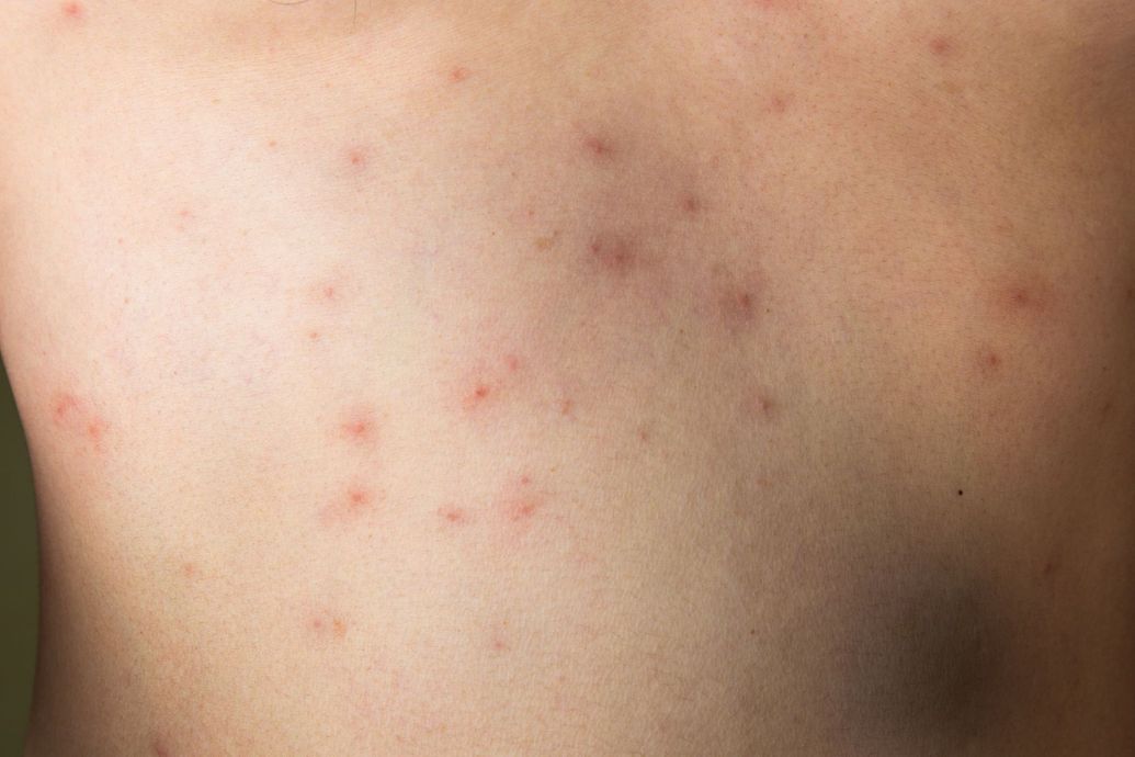 dermatite atopica