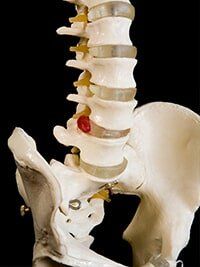 Injections — Spine in Bakersfield, CA Injections — Spine in Bakersfield, CA