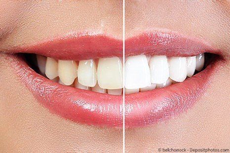 Bleaching - Zahnaufhellung Bleaching - Zahnaufhellung