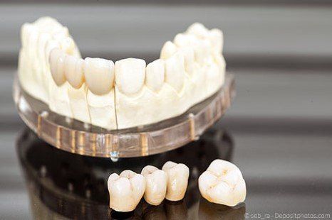 Kronen und Brücken können mit verschiedenen Materialien hergestellt werden. Kronen und Brücken können mit verschiedenen Materialien hergestellt werden.