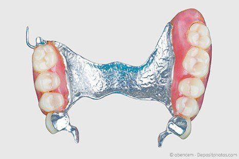 Mit Implantaten können herausnehmbare Teilprothesen oft vermieden werden. Mit Implantaten können herausnehmbare Teilprothesen oft vermieden werden.