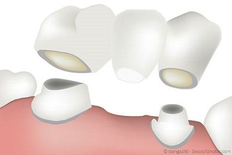Für eine Brücke müssten oft gesunde Zähne abgeschliffen werden. Mit Implantaten kann man das vermeiden. Für eine Brücke müssten oft gesunde Zähne abgeschliffen werden. Mit Implantaten kann man das vermeiden.