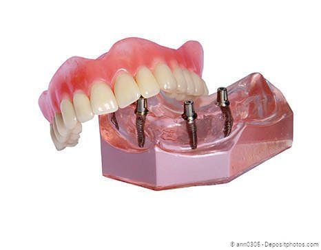 Mit Implantaten kann der Halt von schlecht sitzenden Prothesen erheblich verbessert werden. Mit Implantaten kann der Halt von schlecht sitzenden Prothesen erheblich verbessert werden.