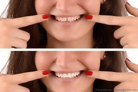 Veneers - Keramikverblendschalen Veneers - Keramikverblendschalen