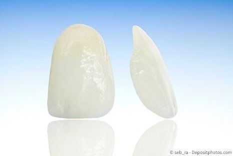 Veneers - hauchdünne Verblendschalen für schöne Zähne