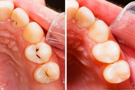 Komposit-Füllungen sind eine gute Alternative zu Amalgam und einfachem Kunststoff. Komposit-Füllungen sind eine gute Alternative zu Amalgam und einfachem Kunststoff.