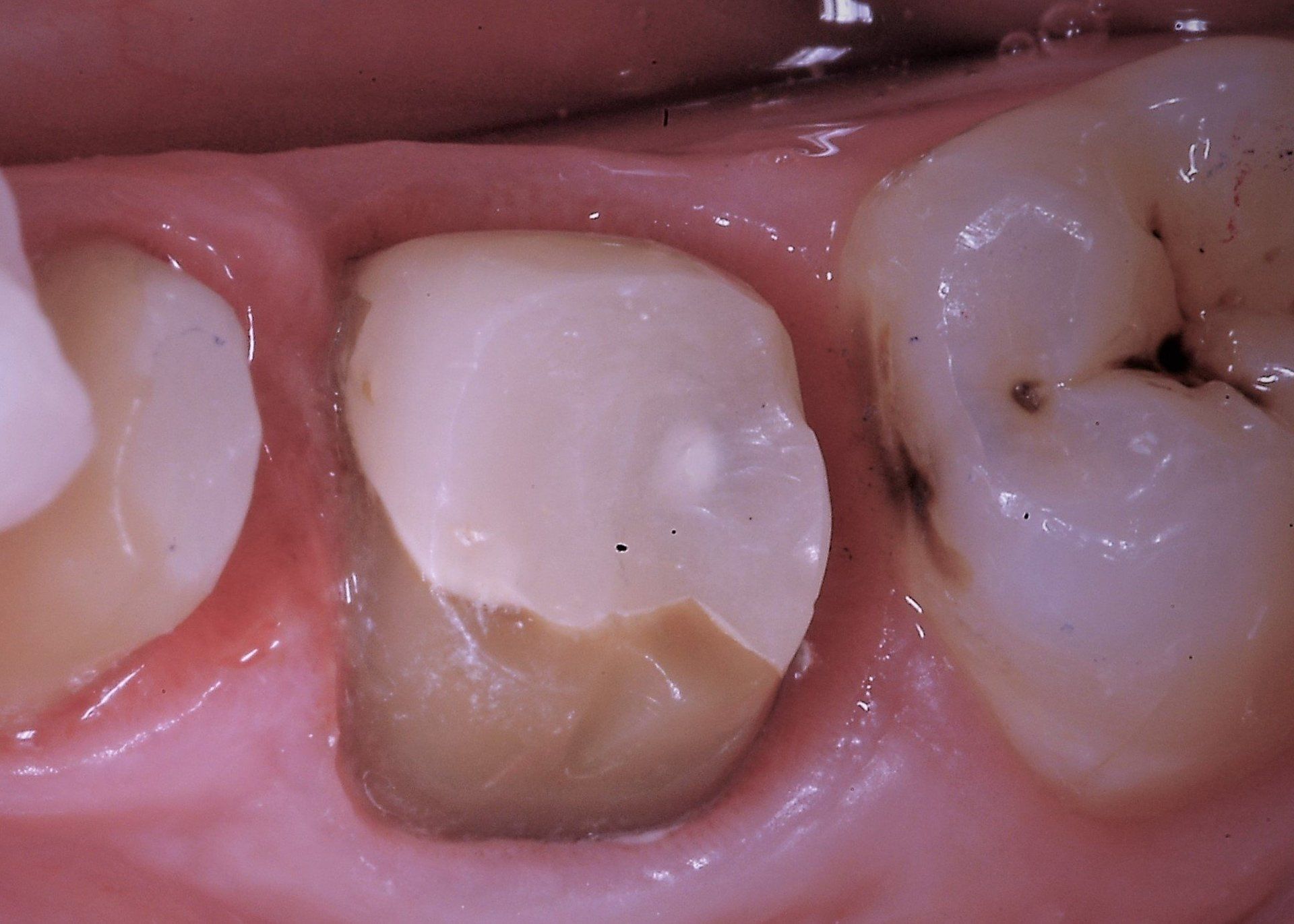 primo piano di denti paziente 20