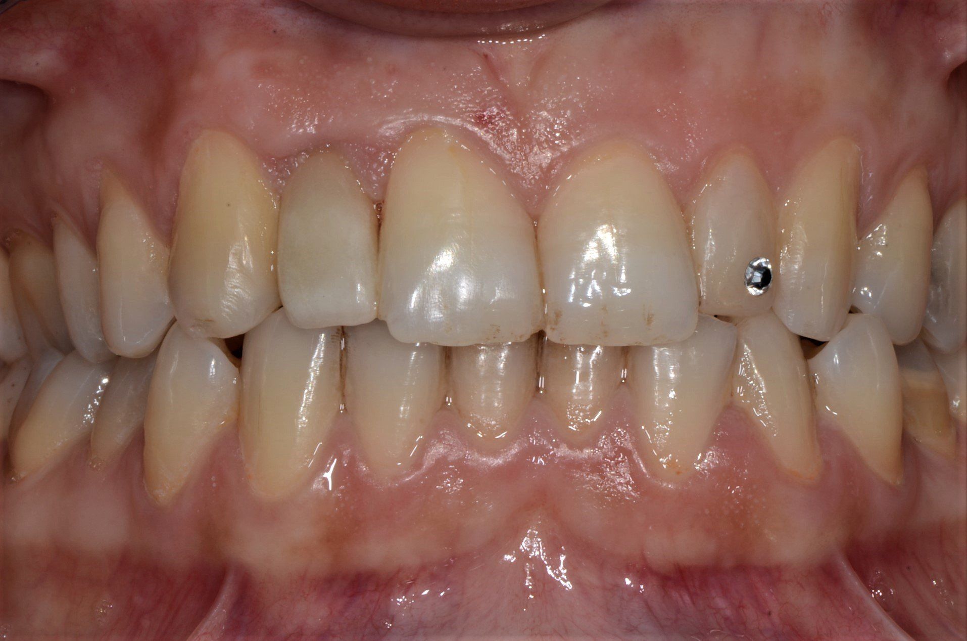 primo piano di denti paziente 13