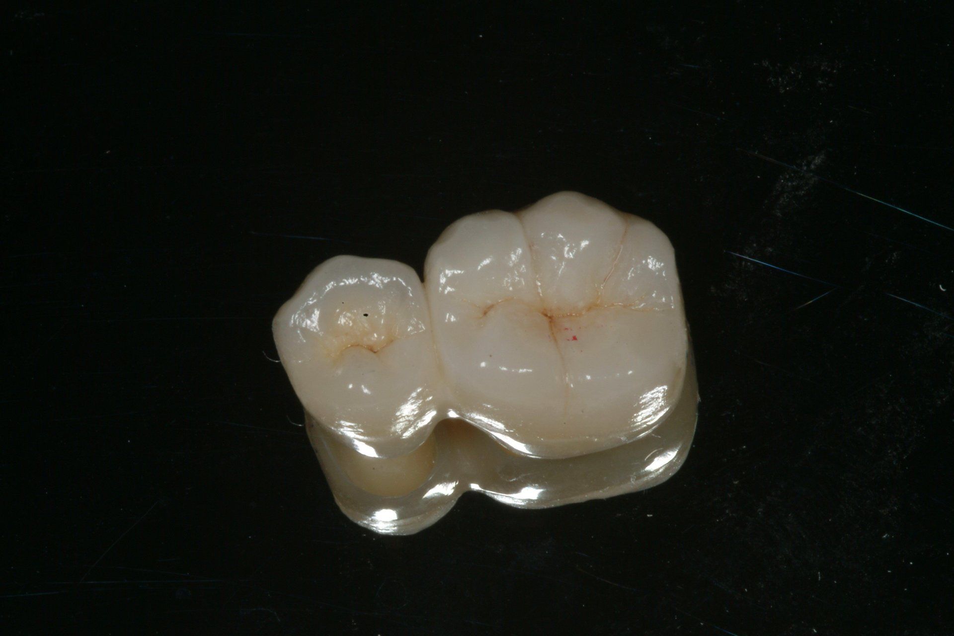 denti con tartaro