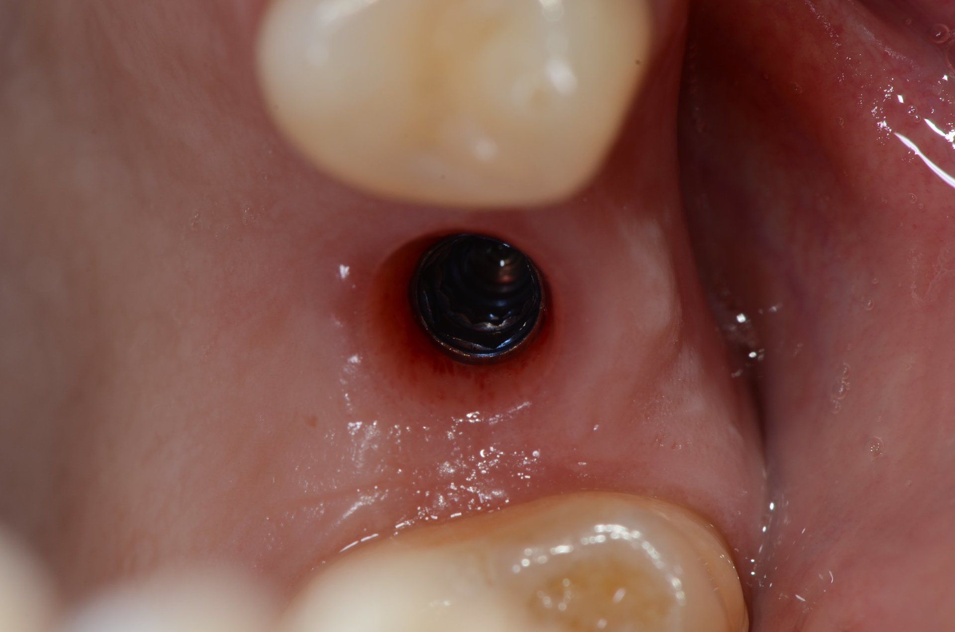 rimozione di denti