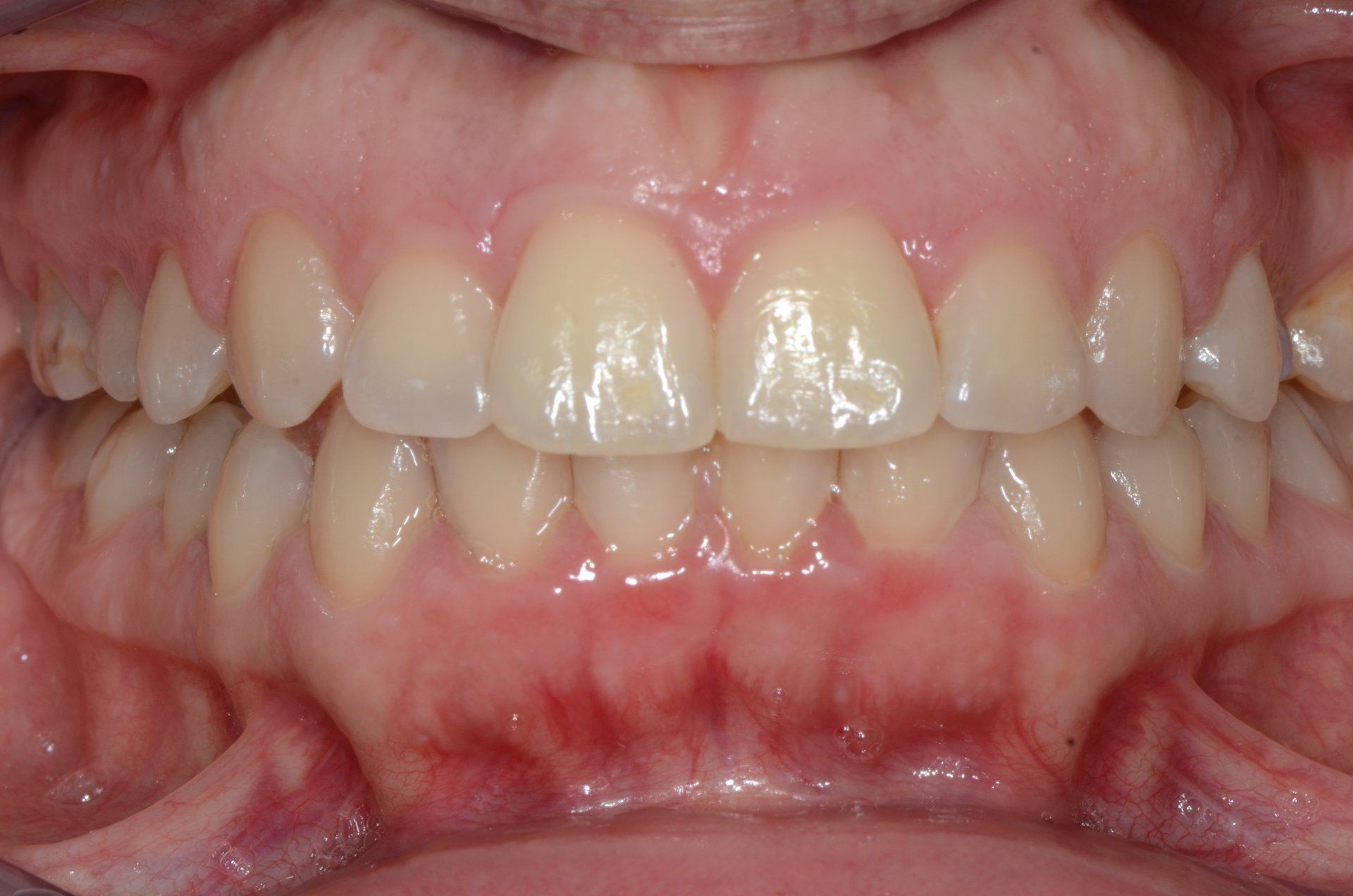 primo piano di denti paziente 7