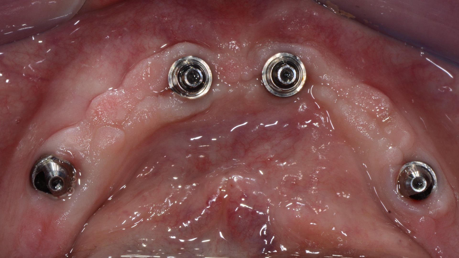 impianto per il sostegno dell'apparato dentale