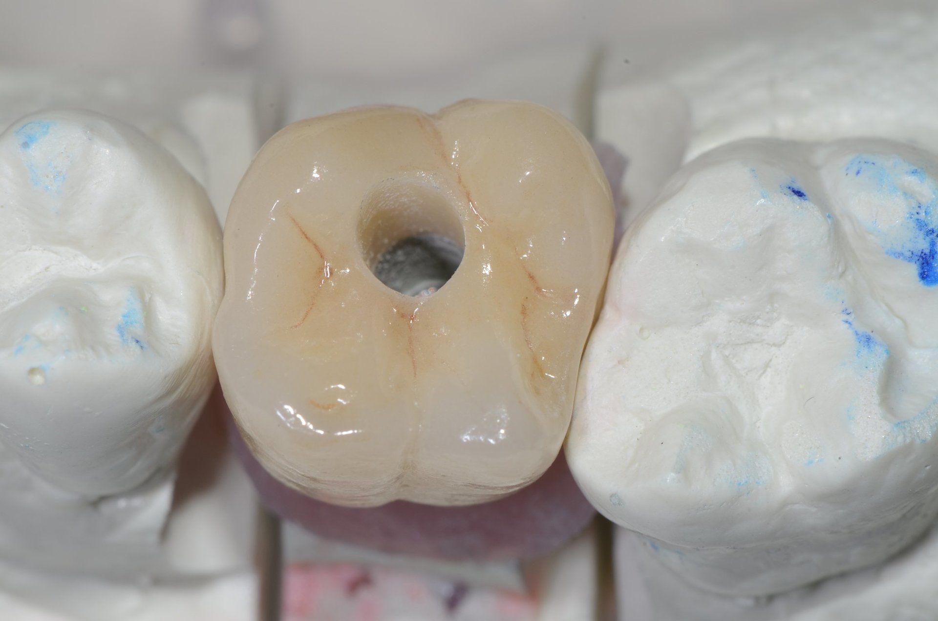dente con foro chirurgico