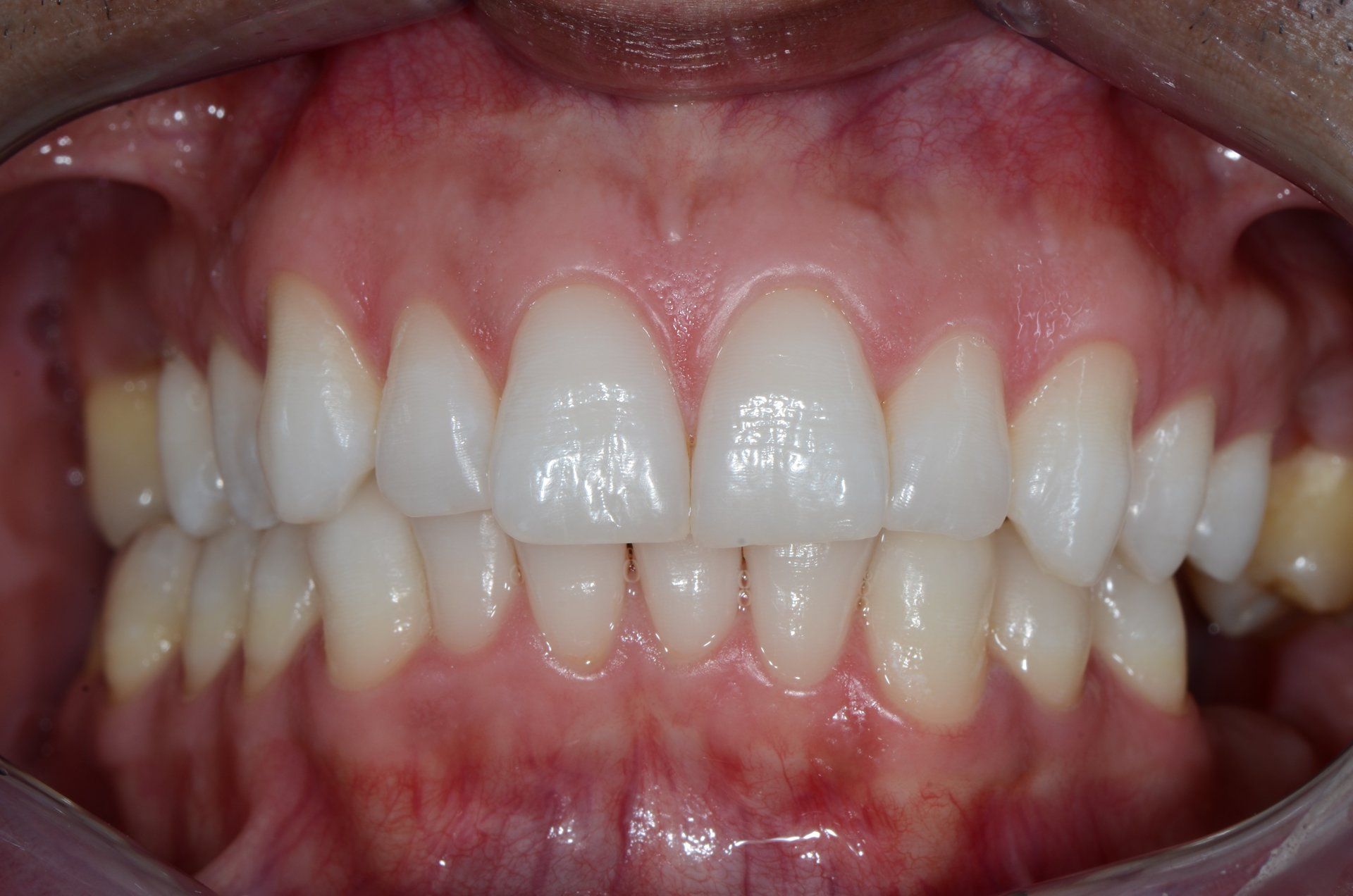 primo piano di denti paziente 2